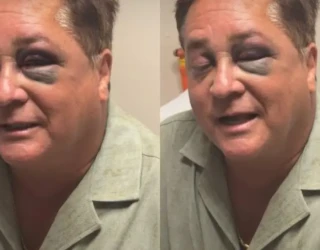 leonardo-exibiu-olho-roxo-apos-acidente-1777054588243_v2_900x506