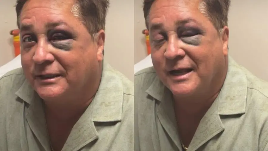 leonardo-exibiu-olho-roxo-apos-acidente-1777054588243_v2_900x506