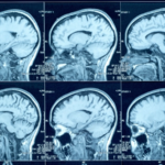 1787609400-creutzfeldt-jakob-e-uma-condicao-neurologica-rara-que-provoca-degeneracao-progressiva-do-cerebro-3389328-article