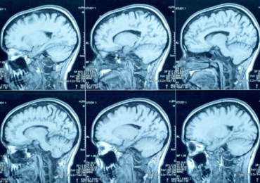 1787609400-creutzfeldt-jakob-e-uma-condicao-neurologica-rara-que-provoca-degeneracao-progressiva-do-cerebro-3389328-article