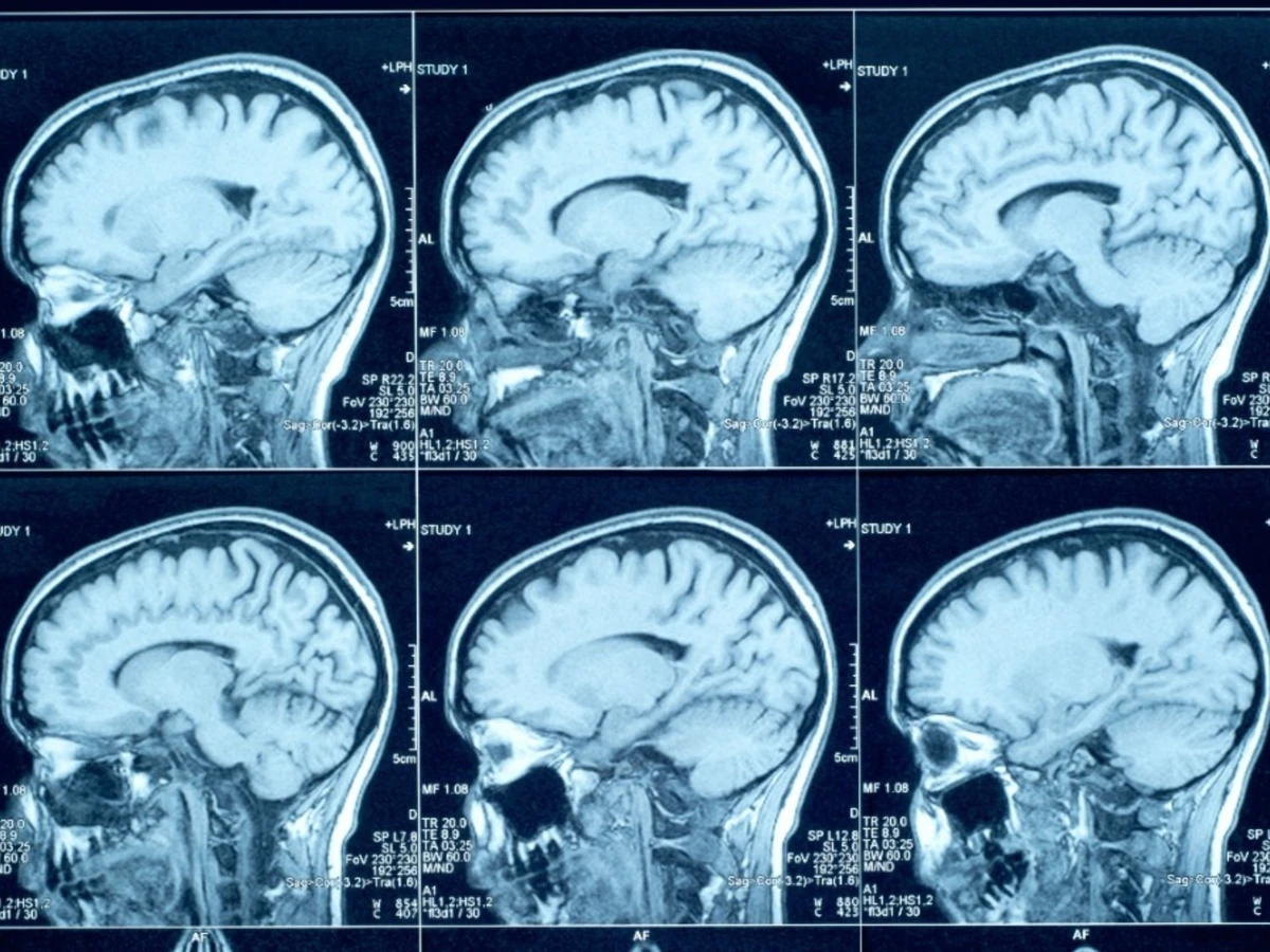 1787609400-creutzfeldt-jakob-e-uma-condicao-neurologica-rara-que-provoca-degeneracao-progressiva-do-cerebro-3389328-article